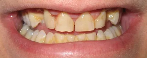Before Full upper porcelain crowns and bridges