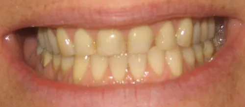 Before 4 Veneers: Upper front teeth