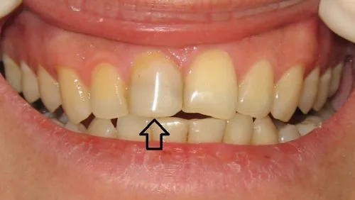 Before Upper front tooth crown and Bonding on right-centre tooth