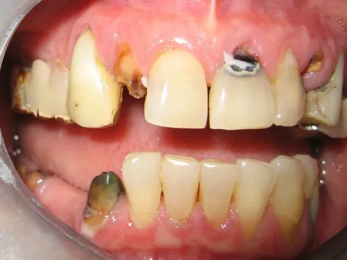Crowns and removable attachment partial dentures with hidden clasps Before #2