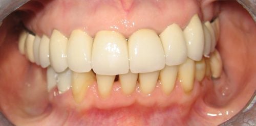 After Replacement upper crowns