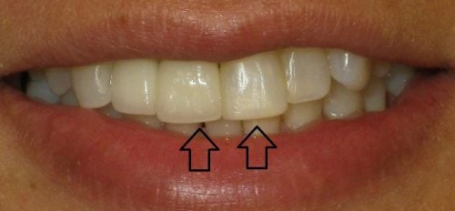 Implant crowns by Thornhill Dental