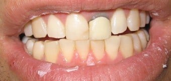 Before Replacement of old crown with an all-ceramic crown, and in-office customization