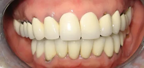 Before: Failing porcelain fused to metal bridgework