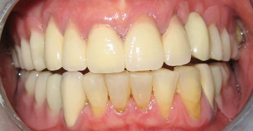Crowns and removable attachment partial dentures with hidden clasps After 2