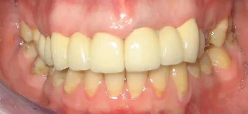 After Replacement upper bridgework, with all porcelain crowns