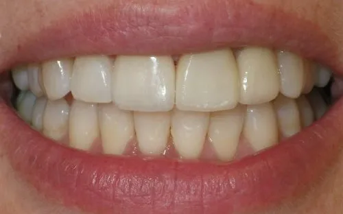 After upper veneers and crowns by Thornhill Dental