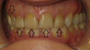 Before ceramic crowns