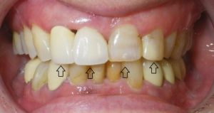 Before porcelain crowns