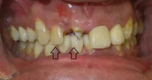 mouth image before dental bonding missing front tooth