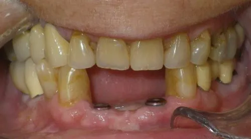 Before implant crowns