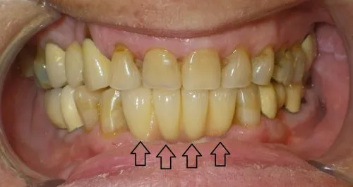 After implant crowns