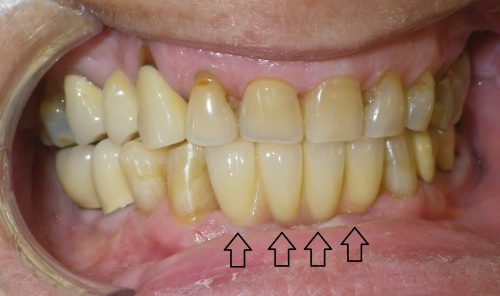 After implant crowns
