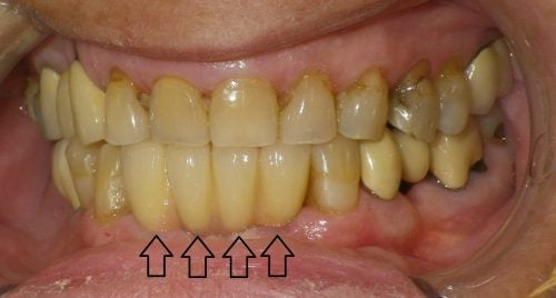 After implant crowns