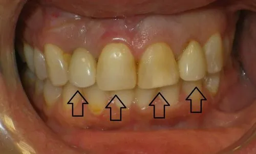 Before 3 Crowns and 1 Implant Crown