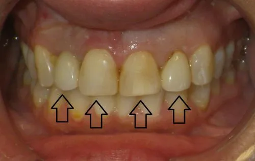 Before 3 Crowns and 1 Implant Crown