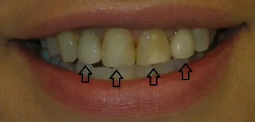 Before 3 Crowns and 1 Implant Crown