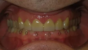 Veneers/ front bottom view
