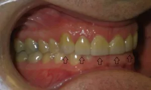Veneers/ side bottom view