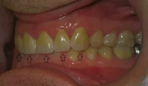 Veneers/ bottom view