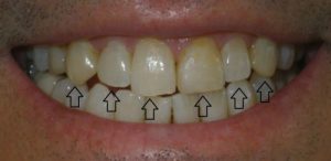 Veneers/ front bottom view/ before