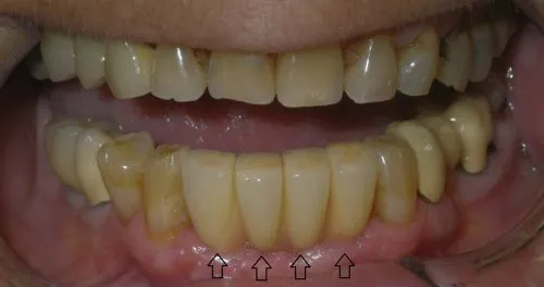 After implant crowns