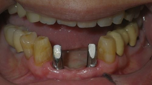 Before implant crowns
