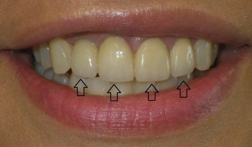 After 3 Crowns and 1 Implant Crown