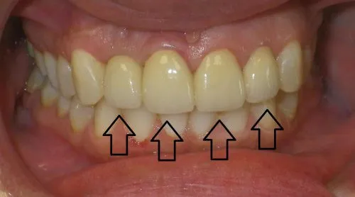 After 3 Crowns and 1 Implant Crown