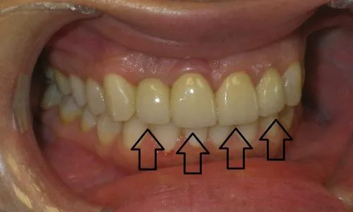 After 3 Crowns and 1 Implant Crown