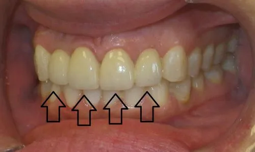 After 3 Crowns and 1 Implant Crown