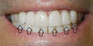 Veneers/ front bottom view/ After