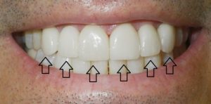 Veneers/ front bottom view/ After