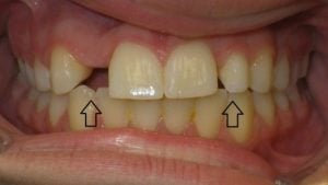 Before cerec crown and bonding - side view of teeth