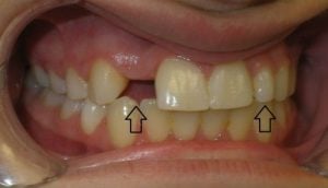 Before cerec crown and bonding - top view of teeth