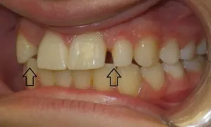 Before cerec crown and bonding - side view of teeth