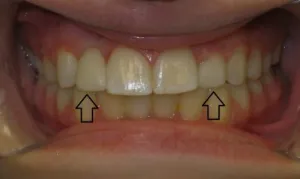 After cerec crown and bonding - bottom view of teeth