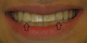 After cerec crown and bonding - bottom view of teeth