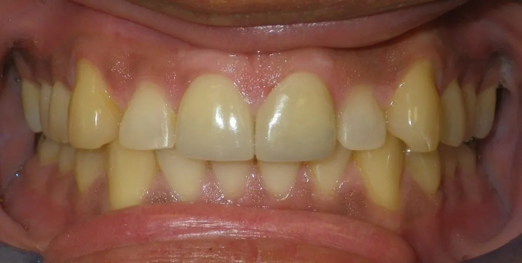 After restoration - aligned and even teeth