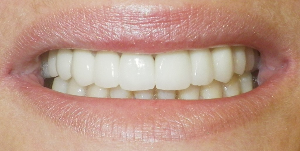 After dental crowns - restored smile