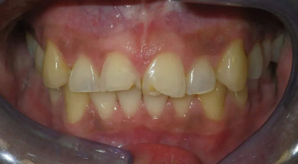Before full mouth restoration - uneven and crooked teeth