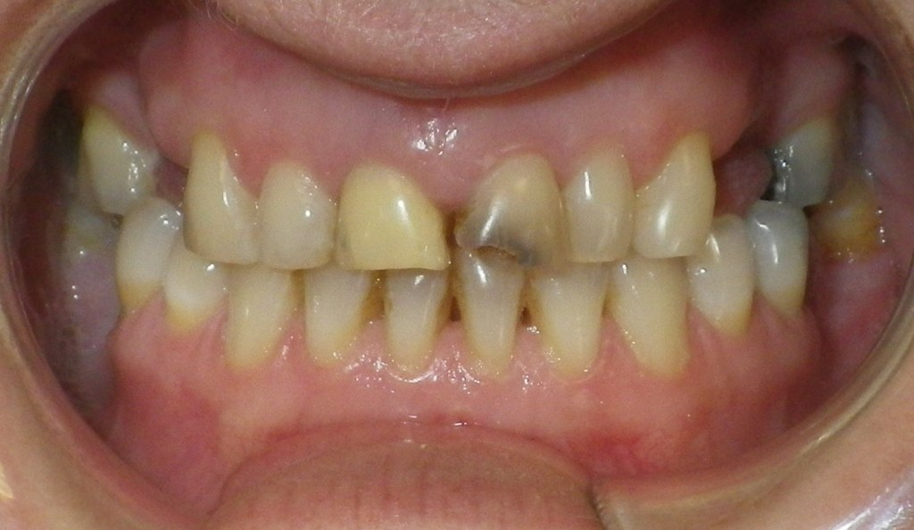 Before dental crowns - discolored teeth